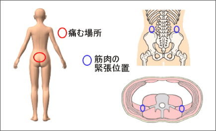 腰痛を治す腰痛アカデミーは腰痛やヘルニア、狭窄症、坐骨神経痛を克服するため坂戸孝志先生により考案された自分で治せる克服法