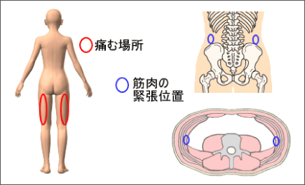 腰痛は腰痛アカデミーで、ヘルニア、狭窄症も治る、更に坐骨神経痛も治す坂戸孝志の名医による腰痛は自分で治せる克服法