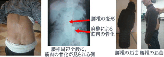 腰痛を腰痛アカデミーで克服させ、ヘルニア、狭窄症、坐骨神経痛等の痛みを改善させるための名医坂戸孝志のサポートを受けられた方腰椎の変形・増井による筋肉の骨化・腰椎周辺全般に筋肉の骨化が見られる例　腰椎屈曲の方①　腰椎の屈曲の方②。